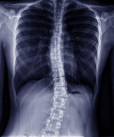 Standard X-ray of the spine